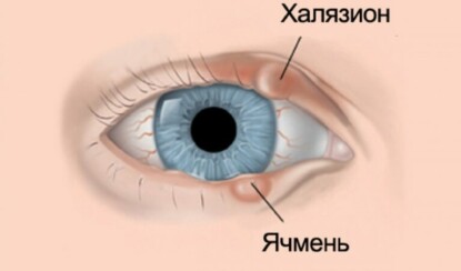 Как отличить ячмень от халязиона