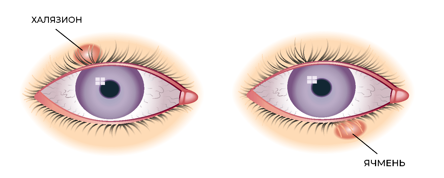 Как отличить ячмень от халязиона